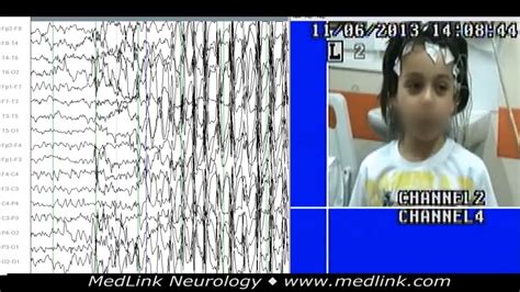 Childhood Absence Epilepsy Cae Medlink Neurology