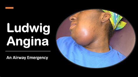 Ludwig Angina An Airway Emergency Youtube