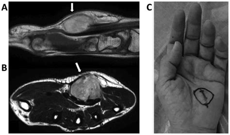 An Aggressive Nodular Fasciitis Lesion Protruding From The Palm Usp6