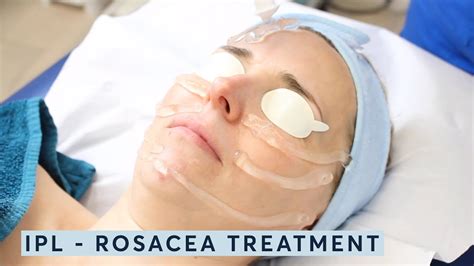 how to treat rosacea ipl youtube