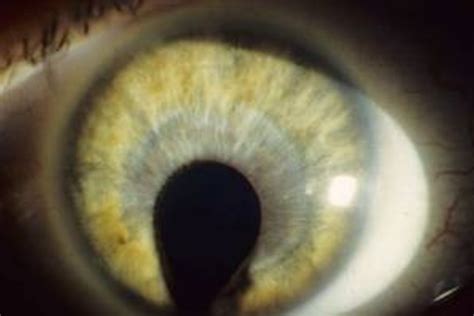 Cat Eye Syndrome Makes Eyes Look Feline Nbc News