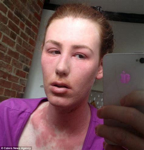 Eczema Sufferer Develops Horrific Reaction After She Stops Using Steroid Cream Daily Mail Online
