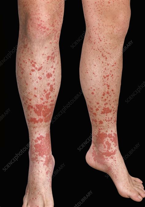 Purpura Rash Stock Image C0494531 Science Photo Library