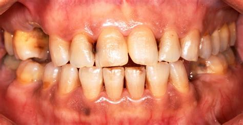 Dip Gum Disease And How Tobacco Effects Your Oral Health