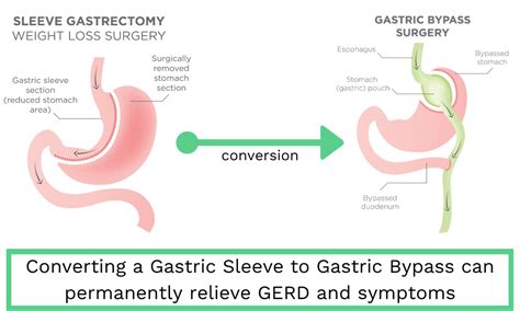 Hiatal Hernia After Gastric Bypass What It Is Complications