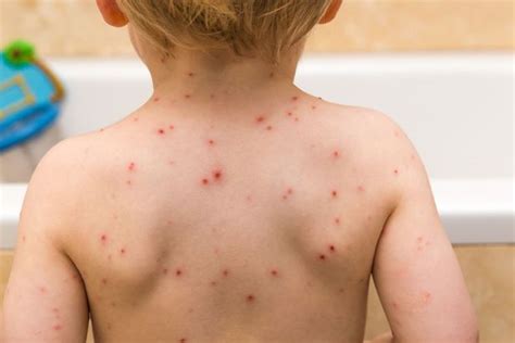 What The Meningitis Rash Looks Like And How To Identify Nine Other