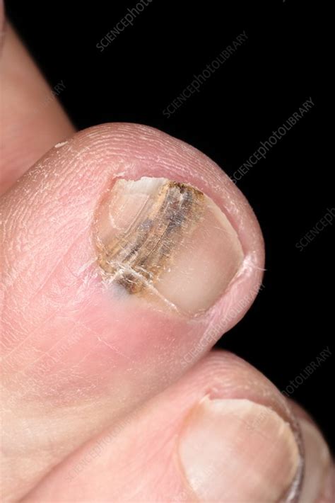 Fungal Nail Infection Stock Image C0532290 Science Photo Library