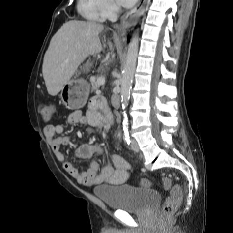 Upper Abdominal Lymphadenopathy Cirrhosis Image