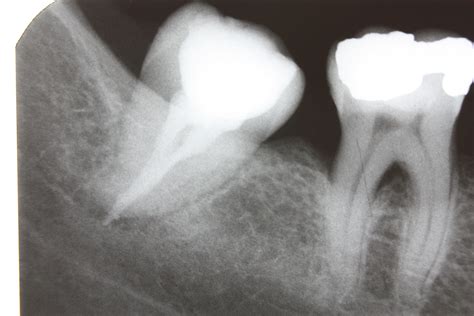 Dental x rays children come in distinct bright colors and descriptive designs. File:Dental X-ray 73.JPG - Wikimedia Commons