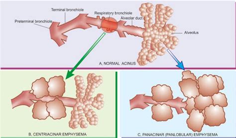 Emphysema