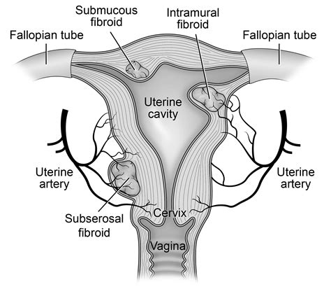 Uterine Artery Embolization Uae To Treat Fibroids Treatments Patients And Families Uw Health