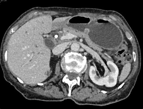Distal Common Bile Duct Dilatation Due To Cbd Tumor Liver Case