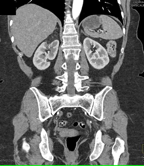 Right Renal Angiomyolipoma Kidney Case Studies Ctisus Ct Scanning