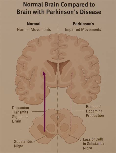 valley neurology understanding parkinson s disease