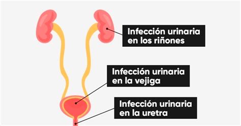 Síntomas De Infección De Orina ⊛ ¡prevención Y Tratamiento 2020