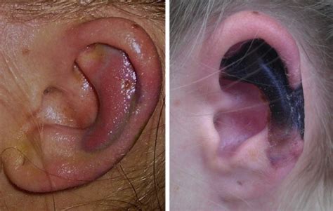 Partial Ear Necrosis Due To Recluse Spider Bite Journal