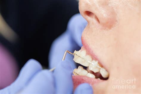 Orthodontist Tightening Braces Photograph By Microgen Images Science Photo Library Fine Art