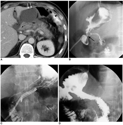 High Output Fistula After Billroth I Operation Due To Stomach