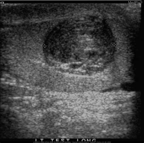 Testicular Cyst Ultrasound