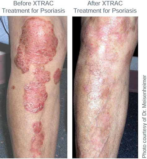 Xtrac Psoriasis Laser Advanced Dermatology Cosmetic Surgery Center