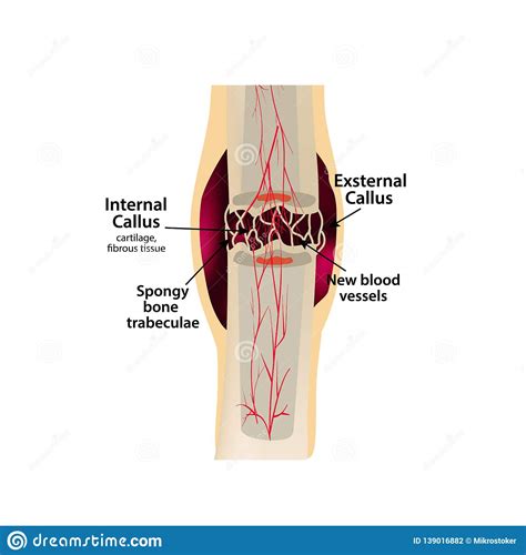 2 Stage Of Healing Bone Fracture Formation Of Callus The Bone Fracture Infographics Vector
