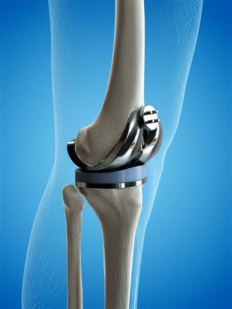 What Exercises Should I Do Immediately After My Knee Replacement