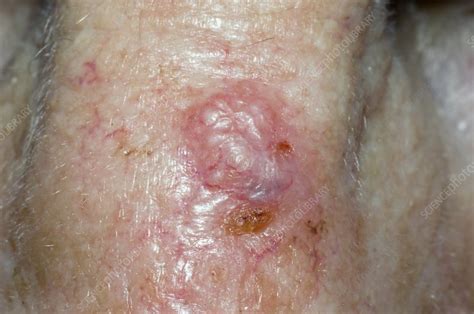 Basal Cell Carcinoma Skin Cancer Nose