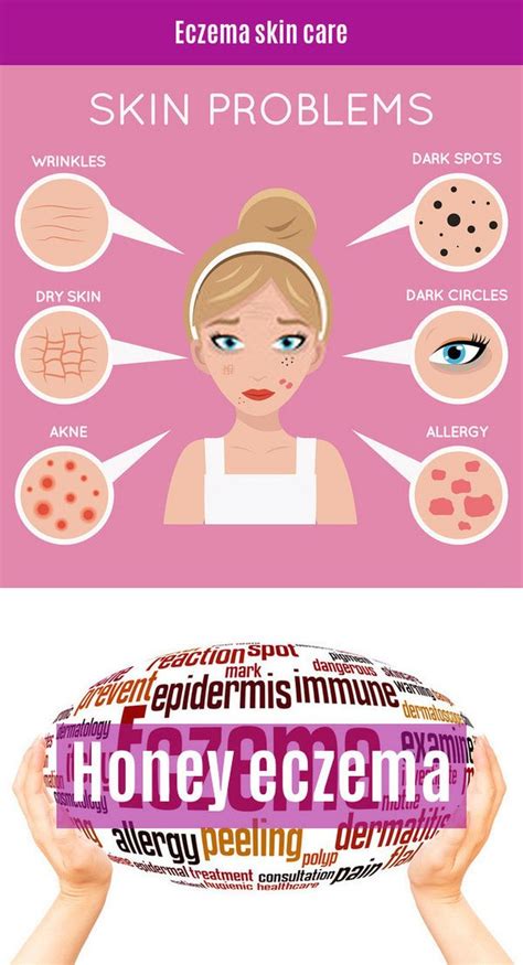 Eczema Treatment Cream In 2020 Eczema Treatment Eczema Skin Care Eczema