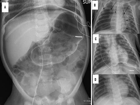 Pneumoperitoneum A Rare Air Leak In An Infant With Bronchiolitis And