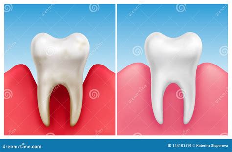 Tooth Periodontitis Or Gingivitis Gum Disease Dental Cartoon 3d