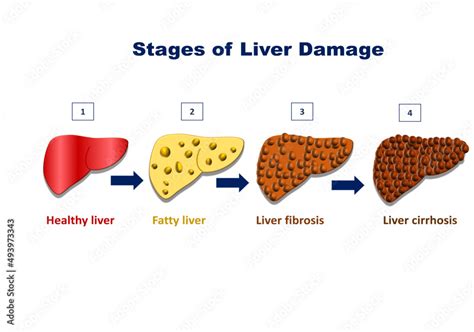 Stages Of Liver Damage Liver Injury Steps Healthy Fatty Liver
