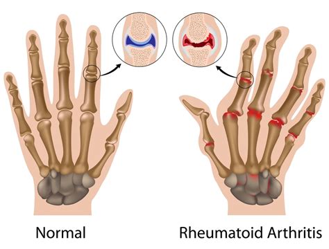 Managing Rheumatoid Arthritis Nps Medicinewise