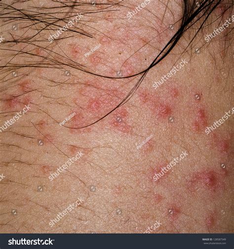 Ill Allergic Rash Dermatitis Eczema Skin Stock Photo Edit Now