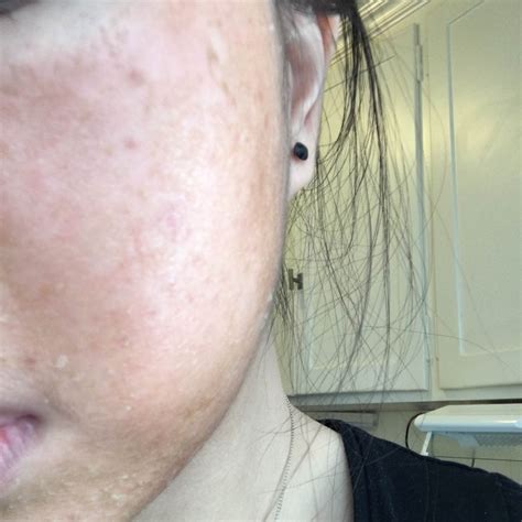 Extremely Red Dry Peeling Skin And Dark Patch With Picture The