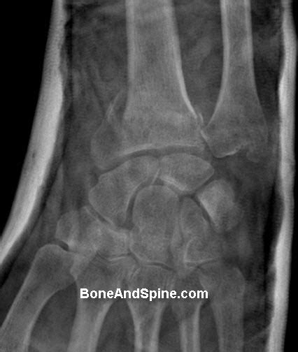 Wrist Injuries X Rays And Photographs Bone And Spine