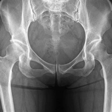 Postoperative Anteroposterior Radiograph Of The Left Hip After Curved