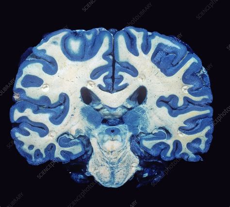 Brain Coronal Section Gray Matter Stock Image C0054964 Science