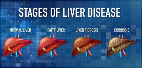 Stages Of Liver Disease Photograph By Kateryna Konsci