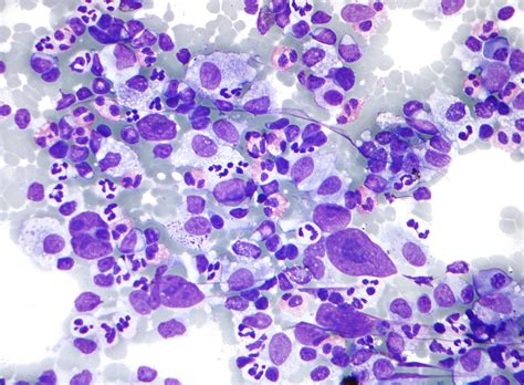 Burkitt lymphoma is considered the most aggressive form of lymphoma and is one of the fastest growing of all cancers. Hodgkin lymphoma - Wikipedia
