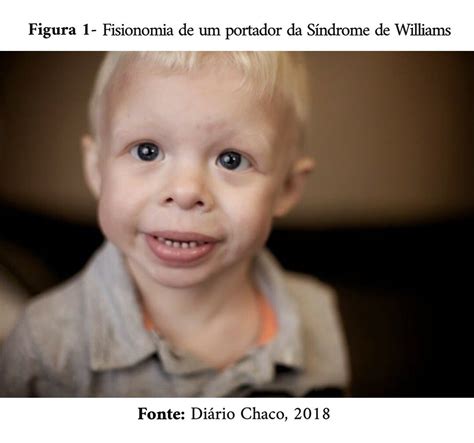 What Are The Signs And Symptoms Of Williams Syndrome Storymd
