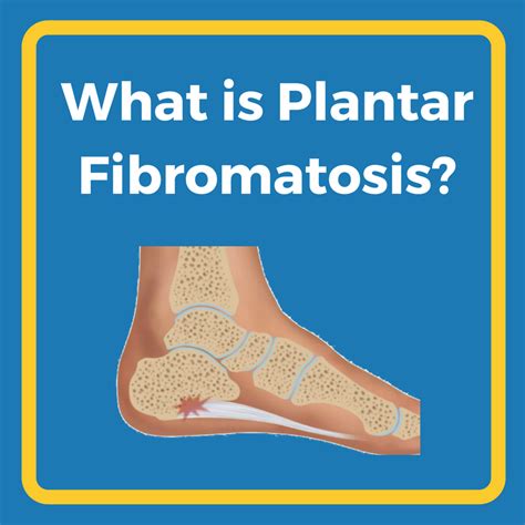 What Is Plantar Fibromatosis Heel That Pain