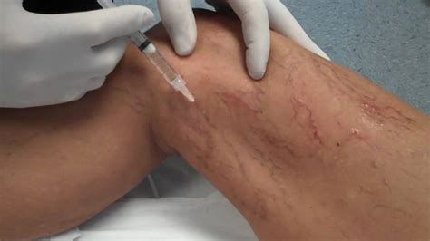 Sclerotherapy The Vein Centre Dr Richard Murbach Treatment For Spider Veins Youtube