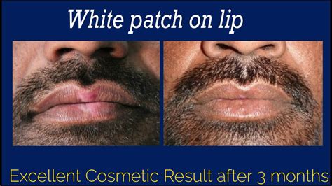 Dont Worry About Lip Vitiligo White Patches Now Cosmetic Surgery With