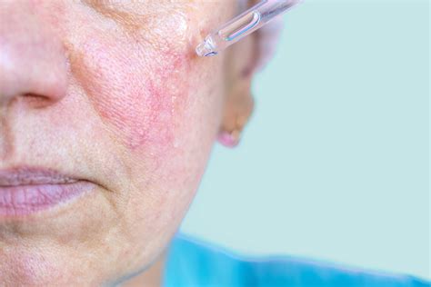 Ask A Dermatologist How To Treat Rosacea The Dose