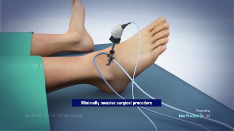 Ankle Arthroscopic Surgery Video Ypo Education
