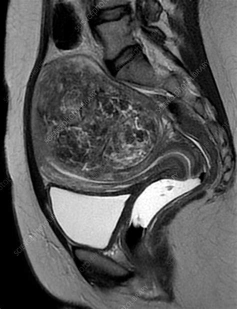 Uterine Fibroid Mri Scan Stock Image C0345653 Science Photo Library
