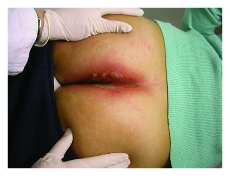A Acute Dermatitis With Edema Erythema Bullous Lesion At The