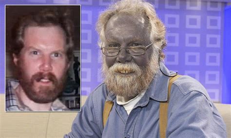 9 Images Of People Who Are Living With A Disorder Called Argyria A