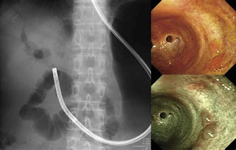 Diagnostic And Therapeutic Peroral Direct Cholangioscopy In Patients