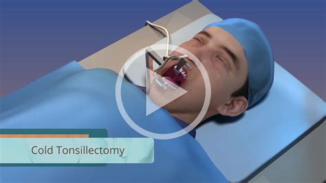 Tonsillectomy The Procedure Silverback Video Llc